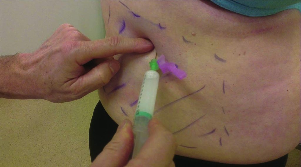 Abdominal Wall Pain – Alpha Hospital Group