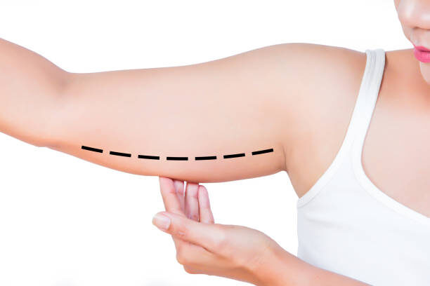 asian woman showing her fat upper arm – Alpha Hospital Group