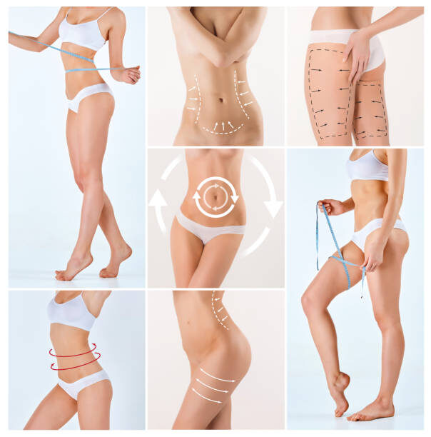Body lift – Alpha Hospital Group
