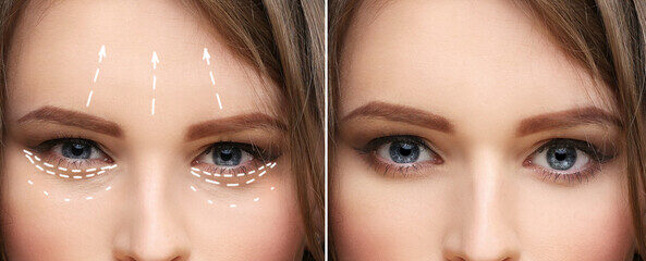 Brow lift – Alpha Hospital Group
