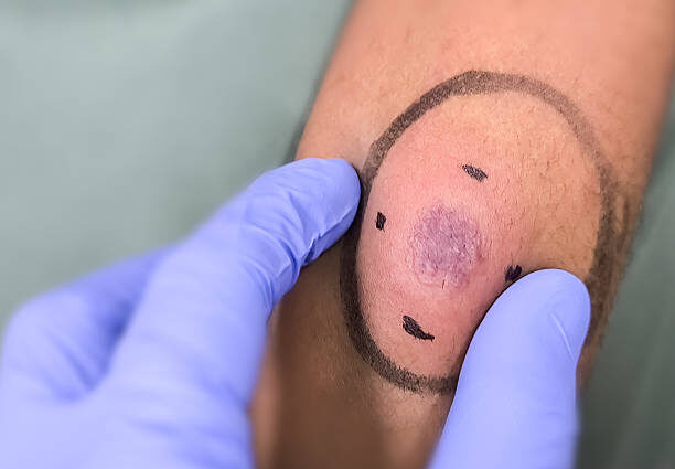 Lesion Removal – Alpha Hospital Group