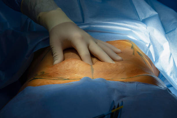 Abdominoplasty in the operating room – Alpha Hospital Group