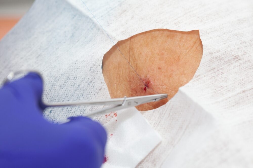 Doctor,Suturing,A,Patient,During,A,Small,Surgery.,Dermatologist,Carrying – Alpha Hospital Group