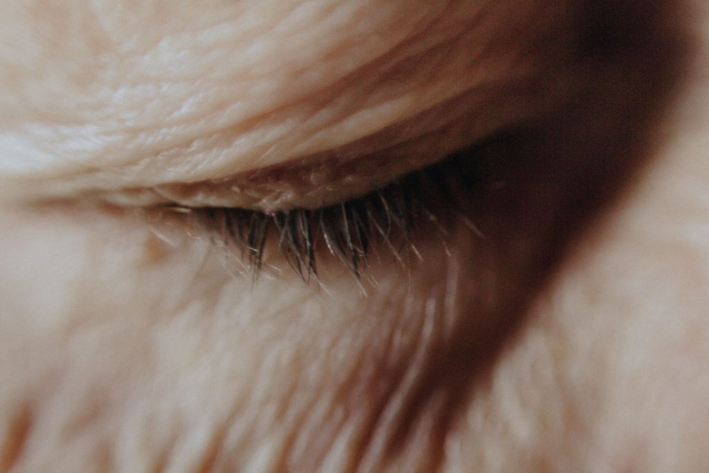 Crow's feet anti-wrinkle treatment area at Alpha Hospital Group