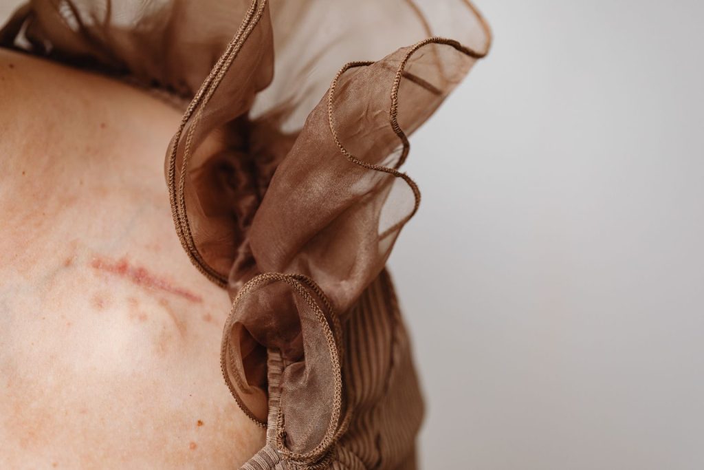 Scar on the skin before keloid excision at Alpha Hospital Group