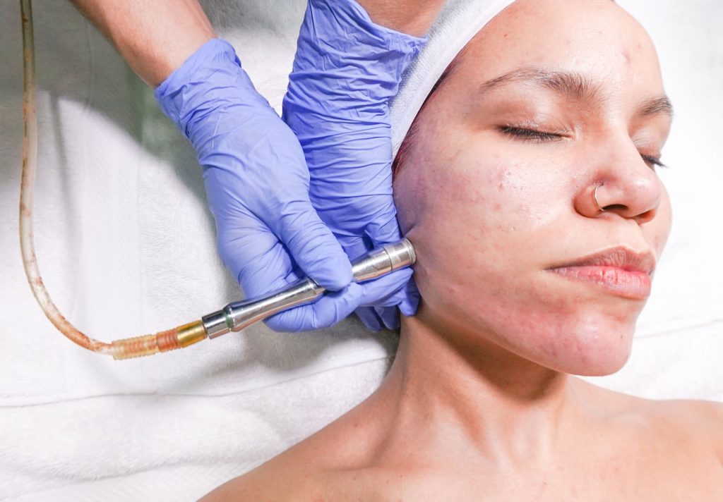 Microneedling / Dermapen treatment at Alpha Hospital Group